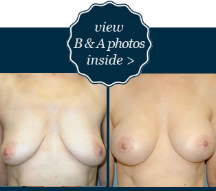 View B&A breast augmentation with lift photos inside