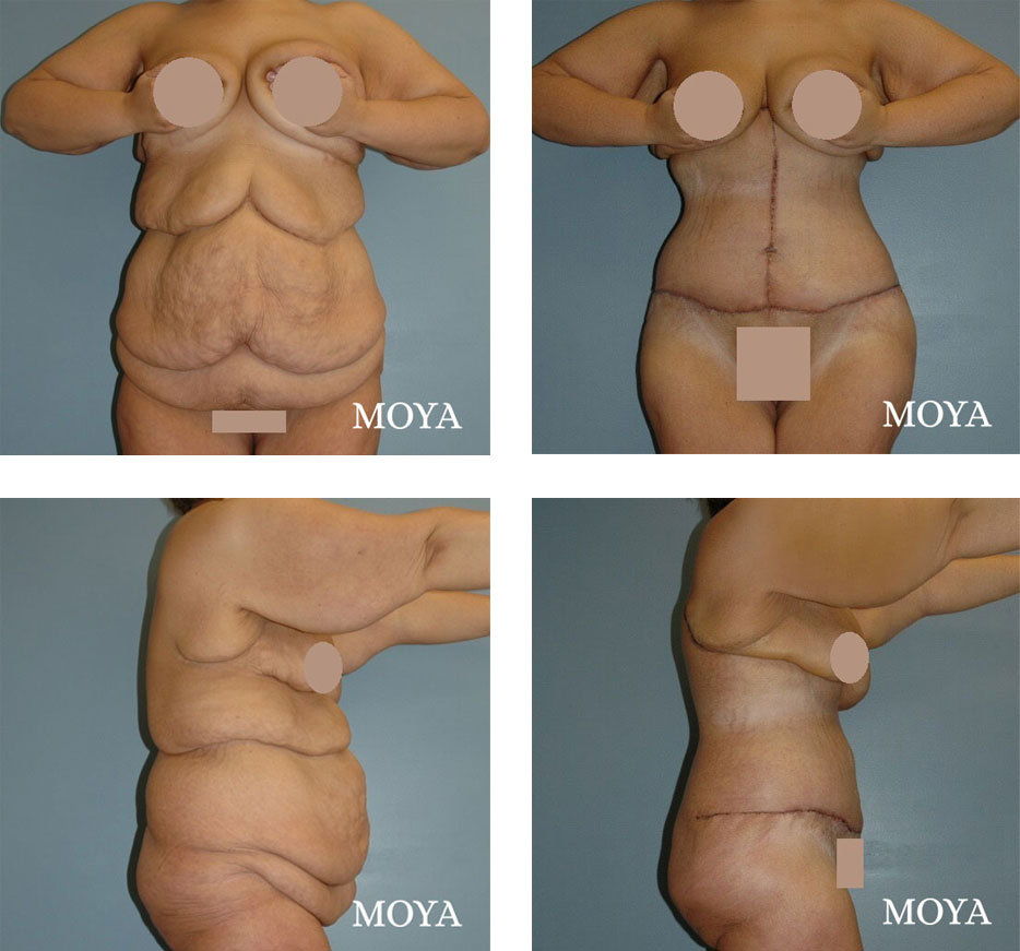 before and after Corset Body Lift, 4 up