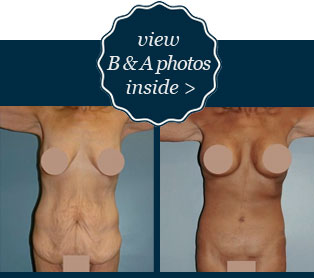 View B&A corset body lift photos inside