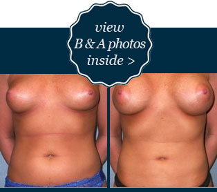 View B&A liposuction photos inside
