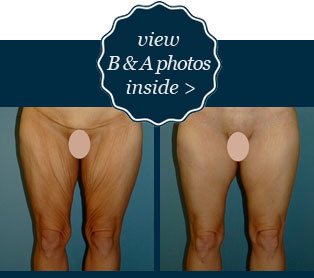 View thigh lift B&A photos inside