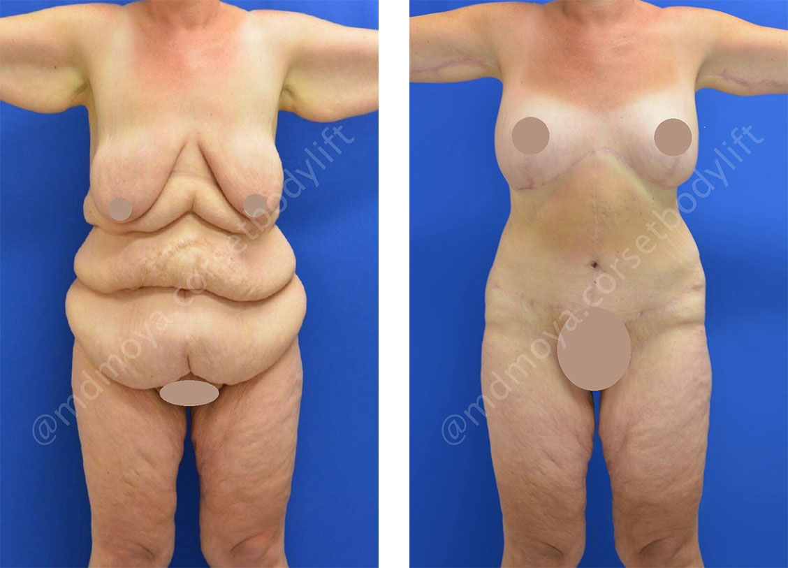 before and after Corset Body Lift, front view